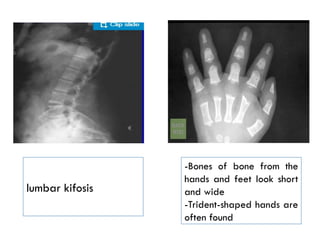 -Bones of bone from the
hands and feet look short
and wide
-Trident-shaped hands are
often found
lumbar kifosis
 
