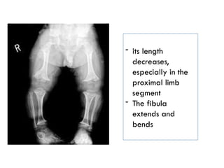 - its length
decreases,
especially in the
proximal limb
segment
- The fibula
extends and
bends
 