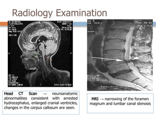 Radiology Examination
Head CT Scan → neuroanatomic
abnormalities consistent with arrested
hydrocephalus, enlarged cranial ventricles,
changes in the corpus callosum are seen.
MRI → narrowing of the foramen
magnum and lumbar canal stenosis
 