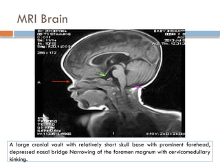 MRI Brain
A large cranial vault with relatively short skull base with prominent forehead,
depressed nasal bridge Narrowing of the foramen magnum with cervicomedullary
kinking.
 
