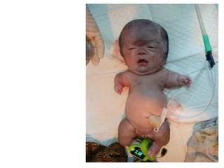 Achondroplasia.pptx.......................