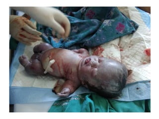 Achondroplasia.pptx.......................