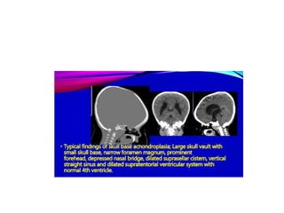 Achondroplasia.pptx.......................