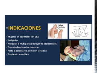 INDICACIONES
Mujeres en edad fértil con VSA
Nuligestas
Nulíparas o Multíparas (incluyendo adolescentes)
Contraindicación de estrógenos
Parto o poscesárea. Con o sin lactancia
Posaborto inmediato
 