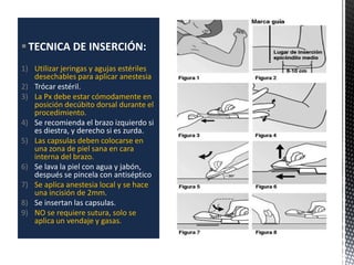 TECNICA DE INSERCIÓN:
1) Utilizar jeringas y agujas estériles
desechables para aplicar anestesia
2) Trócar estéril.
3) La Px debe estar cómodamente en
posición decúbito dorsal durante el
procedimiento.
4) Se recomienda el brazo izquierdo si
es diestra, y derecho si es zurda.
5) Las capsulas deben colocarse en
una zona de piel sana en cara
interna del brazo.
6) Se lava la piel con agua y jabón,
después se pincela con antiséptico
7) Se aplica anestesia local y se hace
una incisión de 2mm.
8) Se insertan las capsulas.
9) NO se requiere sutura, solo se
aplica un vendaje y gasas.
 