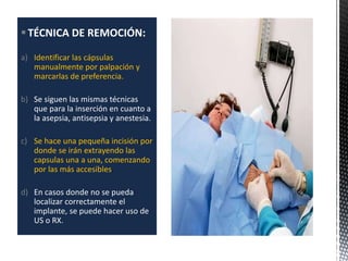 TÉCNICA DE REMOCIÓN:
a) Identificar las cápsulas
manualmente por palpación y
marcarlas de preferencia.
b) Se siguen las mismas técnicas
que para la inserción en cuanto a
la asepsia, antisepsia y anestesia.
c) Se hace una pequeña incisión por
donde se irán extrayendo las
capsulas una a una, comenzando
por las más accesibles.
d) En casos donde no se pueda
localizar correctamente el
implante, se puede hacer uso de
US o RX.
 