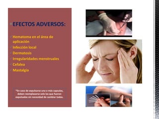 EFECTOS ADVERSOS:
Hematoma en el área de
aplicación
Infección local
Dermatosis
Irregularidades menstruales
Cefalea
Mastalgia
*En caso de expulsarse una o más capsulas,
deben reemplazarse solo las que fueron
expulsadas sin necesidad de cambiar todas.
 
