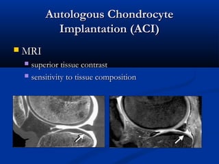 Autologous ChondrocyteAutologous Chondrocyte
Implantation (ACI)Implantation (ACI)
 MRIMRI
 superior tissue contrastsuperior tissue contrast
 sensitivity to tissue compositionsensitivity to tissue composition
 