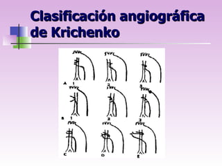 Krichenko Acianóticas flujo pulmonar aumentado | PPT