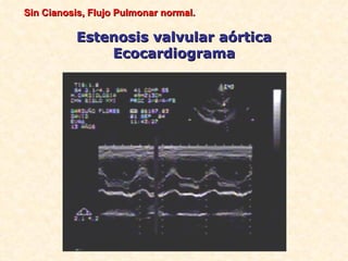 Sin Cianosis, Flujo Pulmonar normal.

          Estenosis valvular aórtica
              Ecocardiograma
 