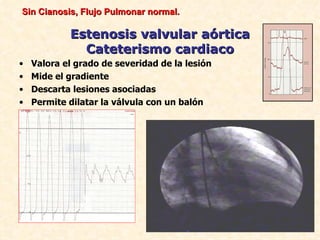 Sin Cianosis, Flujo Pulmonar normal.

            Estenosis valvular aórtica
              Cateterismo cardiaco
•   Valora el grado de severidad de la lesión
•   Mide el gradiente
•   Descarta lesiones asociadas
•   Permite dilatar la válvula con un balón
 