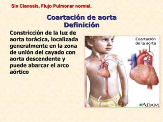 Sin Cianosis, Flujo Pulmonar normal.

               Coartación de aorta
                   Definición
Constricción de la luz de
aorta torácica, localizada
generalmente en la zona
de unión del cayado con
aorta descendente y
puede abarcar el arco
aórtico
 