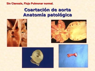 Sin Cianosis, Flujo Pulmonar normal.

            Coartación de aorta
            Anatomía patológica
 