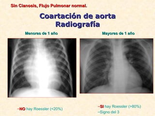 Sin Cianosis, Flujo Pulmonar normal.

              Coartación de aorta
                 Radiografía
      Menores de 1 año                   Mayores de 1 año




                                       –SI hay Roessler (>80%)
   –NO hay Roessler (<20%)
                                       –Signo del 3
 