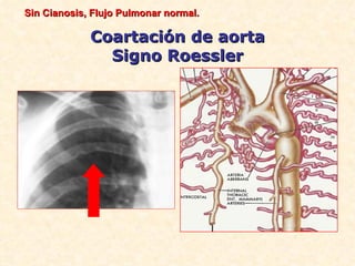 Sin Cianosis, Flujo Pulmonar normal.

             Coartación de aorta
               Signo Roessler
 