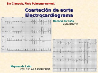 Sin Cianosis, Flujo Pulmonar normal.

             Coartación de aorta
             Electrocardiograma
                                   Menores de 1 año
                                          CVD, BRDHH




  Mayores de 1 año
         CVI, EJE A LA IZQUIERDA
 