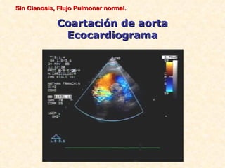 Sin Cianosis, Flujo Pulmonar normal.

             Coartación de aorta
              Ecocardiograma
 