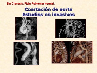Sin Cianosis, Flujo Pulmonar normal.

            Coartación de aorta
           Estudios no invasivos
 