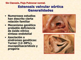 Sin Cianosis, Flujo Pulmonar normal.
          Estenosis valvular aórtica
               Generalidades
• Numerosos estudios
  han descrito cierta
  relación familiar
• Mecanismo genético
  probable deficiencia
  de óxido nítrico
  sintasa endotelial
• Asociación a
  síndromes genéticos:
  Turner (12-38%),
  mucopolisacaridosis y
  progeria
 