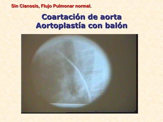Sin Cianosis, Flujo Pulmonar normal.

           Coartación de aorta
          Aortoplastía con balón
 
