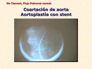 Sin Cianosis, Flujo Pulmonar normal.

            Coartación de aorta
           Aortoplastía con stent
 