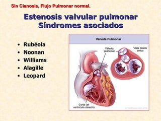 Sin Cianosis, Flujo Pulmonar normal.

      Estenosis valvular pulmonar
         Síndromes asociados

  •   Rubéola
  •   Noonan
  •   Williams
  •   Alagille
  •   Leopard
 
