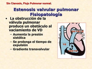 Sin Cianosis, Flujo Pulmonar normal.

     Estenosis valvular pulmonar
           Fisiopatología
• La obstrucción de la
  válvula pulmonar
  produce un obstáculo al
  vaciamiento de VD                           20/10/15
   – Aumenta la presión
     sistólica
   – Se prolonga el tiempo de
     expulsión                         10

   – Gradiente transvalvular                100/10
 