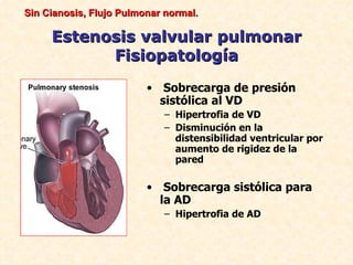 Sin Cianosis, Flujo Pulmonar normal.

     Estenosis valvular pulmonar
           Fisiopatología
                         • Sobrecarga de presión
                           sistólica al VD
                            – Hipertrofia de VD
                            – Disminución en la
                              distensibilidad ventricular por
                              aumento de rigidez de la
                              pared

                         • Sobrecarga sistólica para
                           la AD
                            – Hipertrofia de AD
 