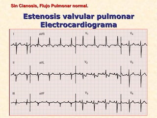 Sin Cianosis, Flujo Pulmonar normal.

     Estenosis valvular pulmonar
         Electrocardiograma
 