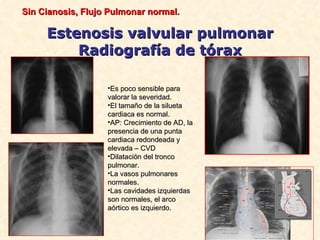 Sin Cianosis, Flujo Pulmonar normal.

     Estenosis valvular pulmonar
         Radiografía de tórax

                   •Es poco sensible para
                   valorar la severidad.
                   •El tamaño de la silueta
                   cardiaca es normal.
                   •AP: Crecimiento de AD, la
                   presencia de una punta
                   cardiaca redondeada y
                   elevada – CVD
                   •Dilatación del tronco
                   pulmonar.
                   •La vasos pulmonares
                   normales.
                   •Las cavidades izquierdas
                   son normales, el arco
                   aórtico es izquierdo.
 