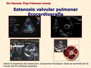 Sin Cianosis, Flujo Pulmonar normal.

           Estenosis valvular pulmonar
                 Ecocardiografía




Valorar la importancia de la obstrucción, Compromiso Infundibular, Grado de hipertrofia del VD.
Función del VD y Defectos asociados
 