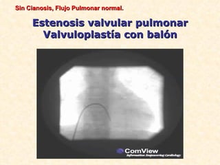 Sin Cianosis, Flujo Pulmonar normal.

     Estenosis valvular pulmonar
       Valvuloplastía con balón
 