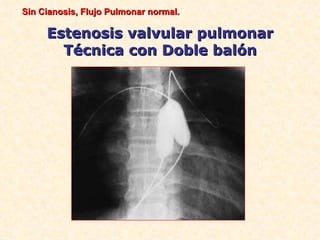 Sin Cianosis, Flujo Pulmonar normal.

     Estenosis valvular pulmonar
       Técnica con Doble balón
 