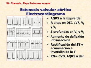 Sin Cianosis, Flujo Pulmonar normal.

          Estenosis valvular aórtica
             Electrocardiograma
                                • AQRS a la izquierda
                                • R altas en DII, aVF, V5
                                  y V6
                                • S profundas en V1 y V2
                                • Aumento de deflexión
                                  intrinsecoide
                                • Rectificación del ST y
                                  acuminación e
                                  inversión de la T
                                • RN= CVD, AQRS a der
 