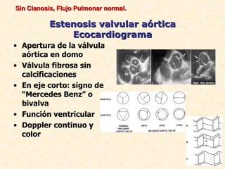 Sin Cianosis, Flujo Pulmonar normal.

          Estenosis valvular aórtica
              Ecocardiograma
• Apertura de la válvula
  aórtica en domo
• Válvula fibrosa sin
  calcificaciones
• En eje corto: signo de
  “Mercedes Benz” o
  bivalva
• Función ventricular
• Doppler continuo y
  color
 