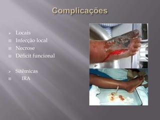  Locais
 Infecção local
 Necrose
 Déficit funcional
 Sitêmicas
 IRA
 