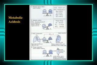 Metabolic
Acidosis
 