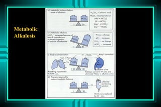 Metabolic
Alkalosis
 