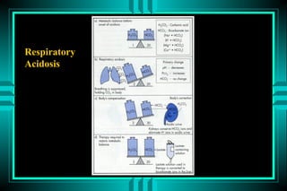 Respiratory
Acidosis
 