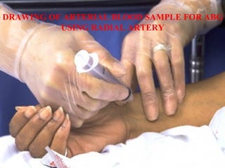 DRAWING OF ARTERIAL BLOOD SAMPLE FOR ABG
USING RADIAL ARTERY
 