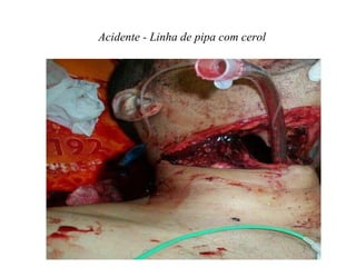 Acidente - Linha de pipa com cerol
 