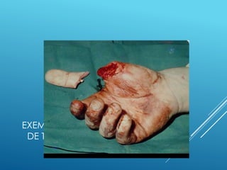 EXEMPLO DE LESÃO COM PERCA
DE TEMPO OU INCAPACITANTE
 