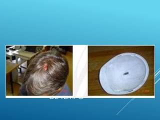 EXEMPLO DE LESÃO SEM PERCA
DE TEMPO
 