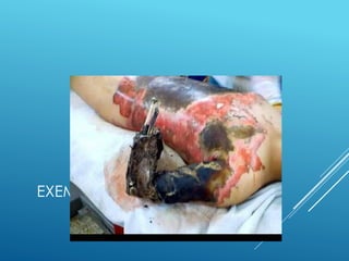 EXEMPLO DE INCAPACIDADE
TOTAL PERMANENTE
 