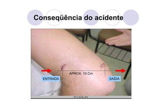 Conseqüência do acidente
ENTRADA SAÍDA
APROX. 10 Cm
 