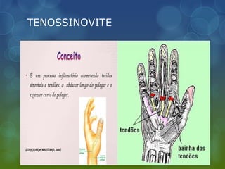 TENOSSINOVITE
 