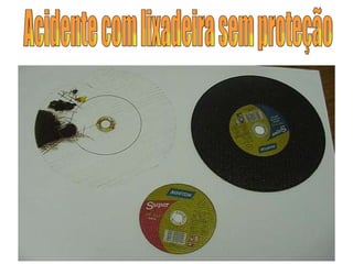Acidente com lixadeira sem proteção 