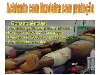 Conseqüências: Perna esquerda seriamente atingida Perda de aprox 50% do sangue Chegou a ter 90% de chance de óbito Perna direita amputada Acidente com lixadeira sem proteção 
