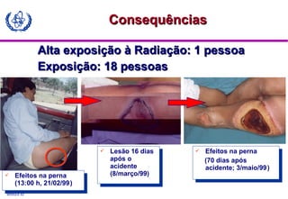 MODULE A3
Alta exposição à Radiação: 1 pessoaAlta exposição à Radiação: 1 pessoa
Exposição: 18 pessoasExposição: 18 pessoas
 Lesão 16 dias
após o
acidente
(8/março/99)
 Lesão 16 dias
após o
acidente
(8/março/99)
 Efeitos na perna
(70 dias após
acidente; 3/maio/99)
 Efeitos na perna
(70 dias após
acidente; 3/maio/99)
 Efeitos na perna
(13:00 h, 21/02/99)
 Efeitos na perna
(13:00 h, 21/02/99)
ConsequênciasConsequências
 
