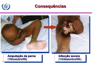MODULE A3
Amputação da pernaAmputação da perna
(18/outubro/99)(18/outubro/99)
Amputação da pernaAmputação da perna
(18/outubro/99)(18/outubro/99)
Infecção severaInfecção severa
(14/dezembro/99(14/dezembro/99))
Infecção severaInfecção severa
(14/dezembro/99(14/dezembro/99))
ConsequênciasConsequências
 